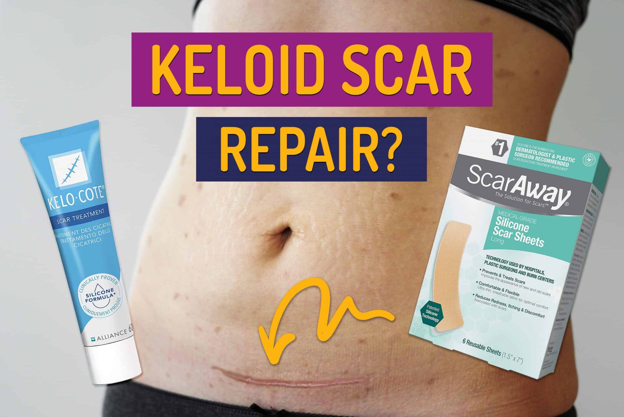 What Causes Keloids After A CSection (And How To Prevent Them) Bumps